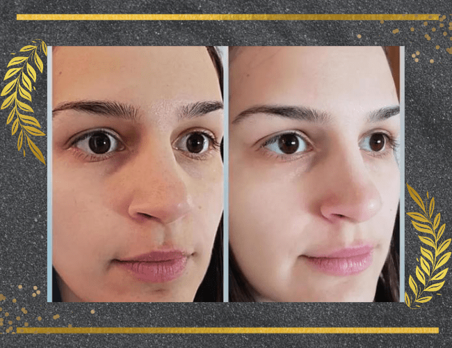 Before and after Use of Bubble skincare for acne 
