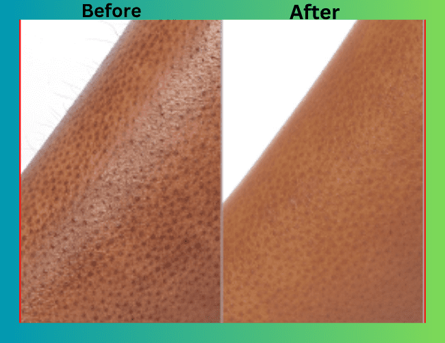 Laser hair removal of Legs before and after