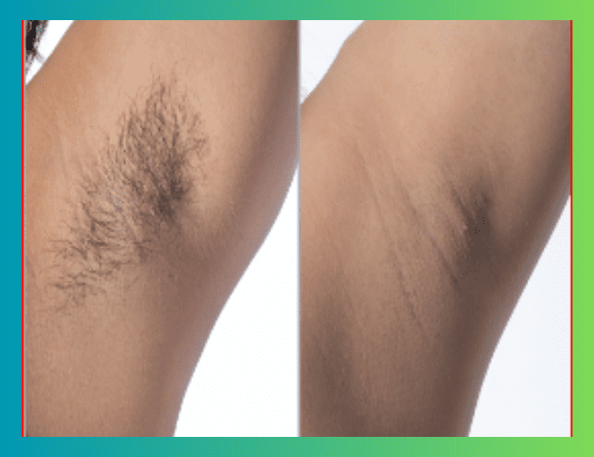 laser hair removal of underarms before and after