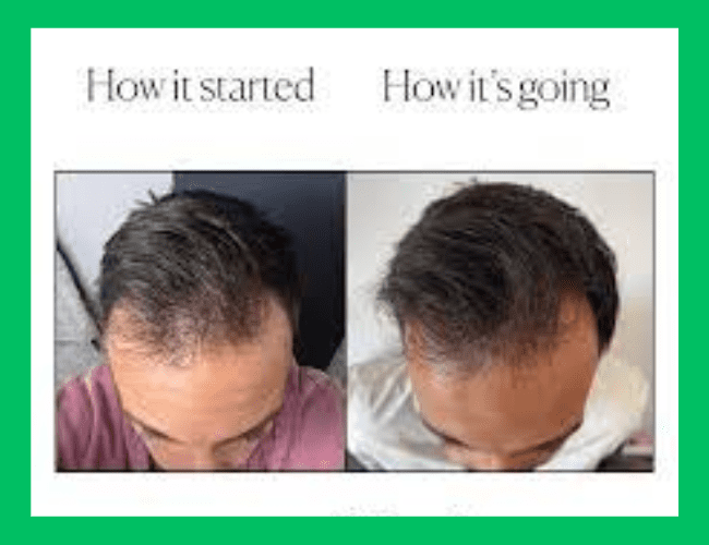 Before and after use of Wellbel hair Vitamins