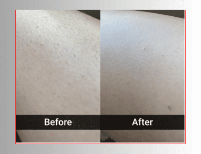 5MINSKIN REVIEWS ⚠️((ALERT!))⚠️ DOES 5MINSKIN LASER HAIR REMOVAL WORK? 5  MIN SKIN HAIR REMOVAL 