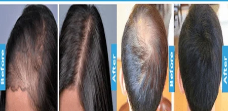 Kera XL Hair Growth Serum Promote Healthy Hair Growth Naturally