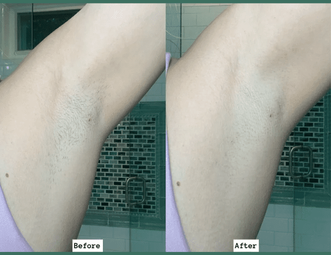 Before and after use of Ulike Laser Hair Removal