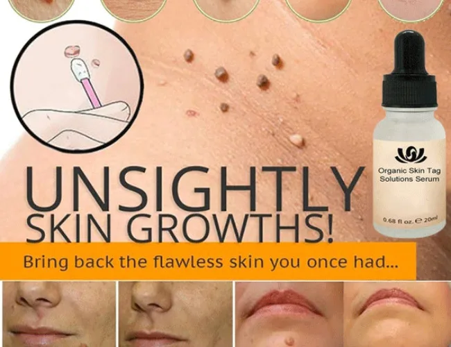 Unsightly skin Growths and Customer Satisfaction