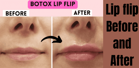 Lip flip before and after