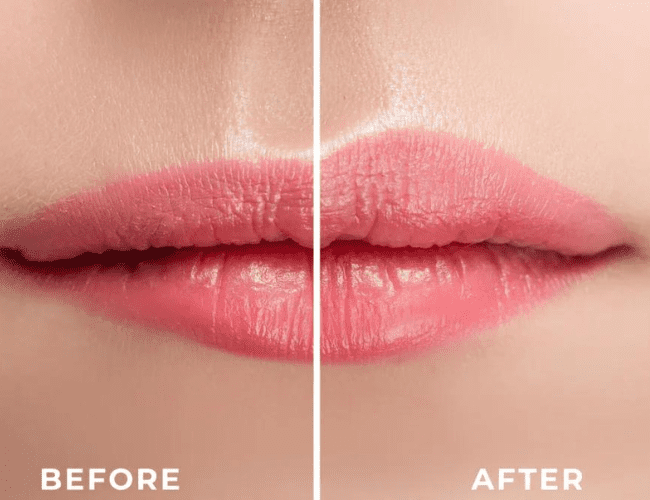 Lip Flip Before And After Exploring The Transformative Power