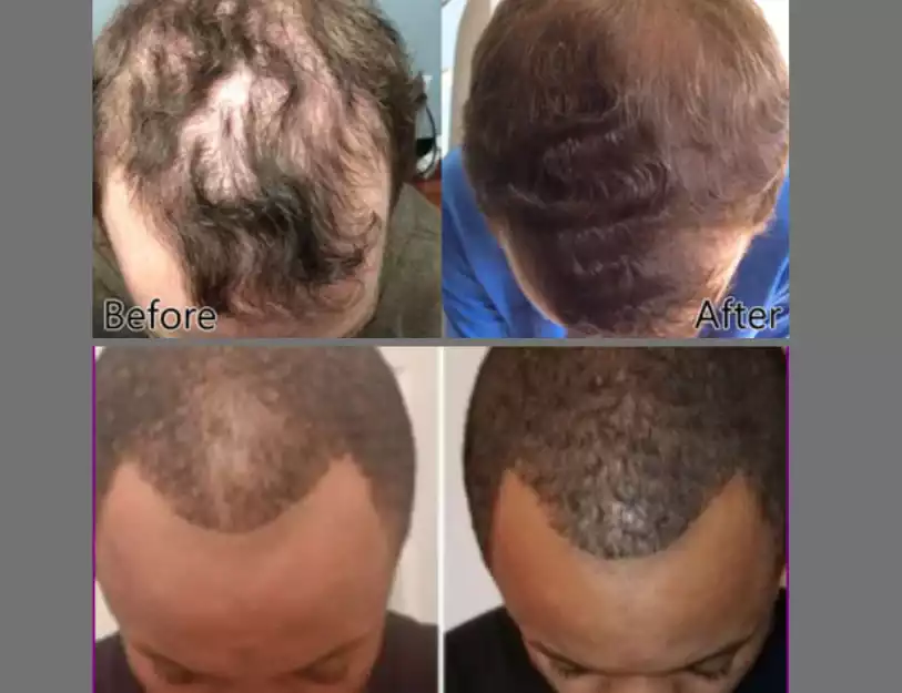 Hair Growth-X products effects