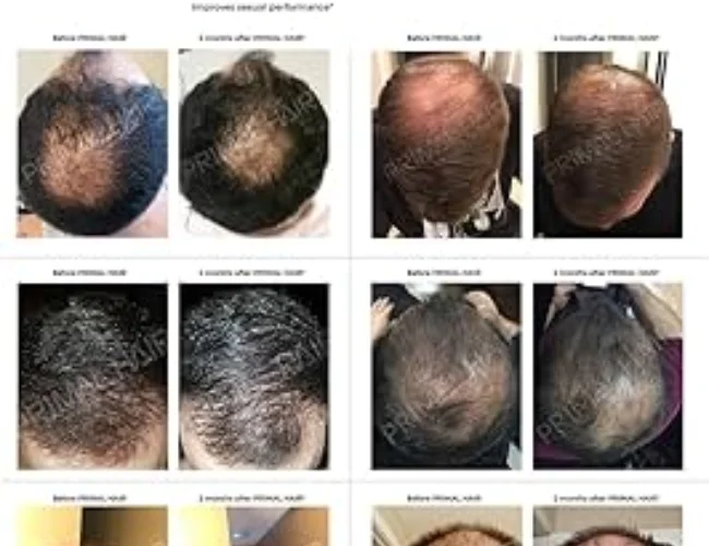Before and after use of innerx hair growth