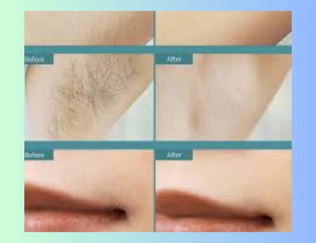 Glimpse of before and after Hair removal